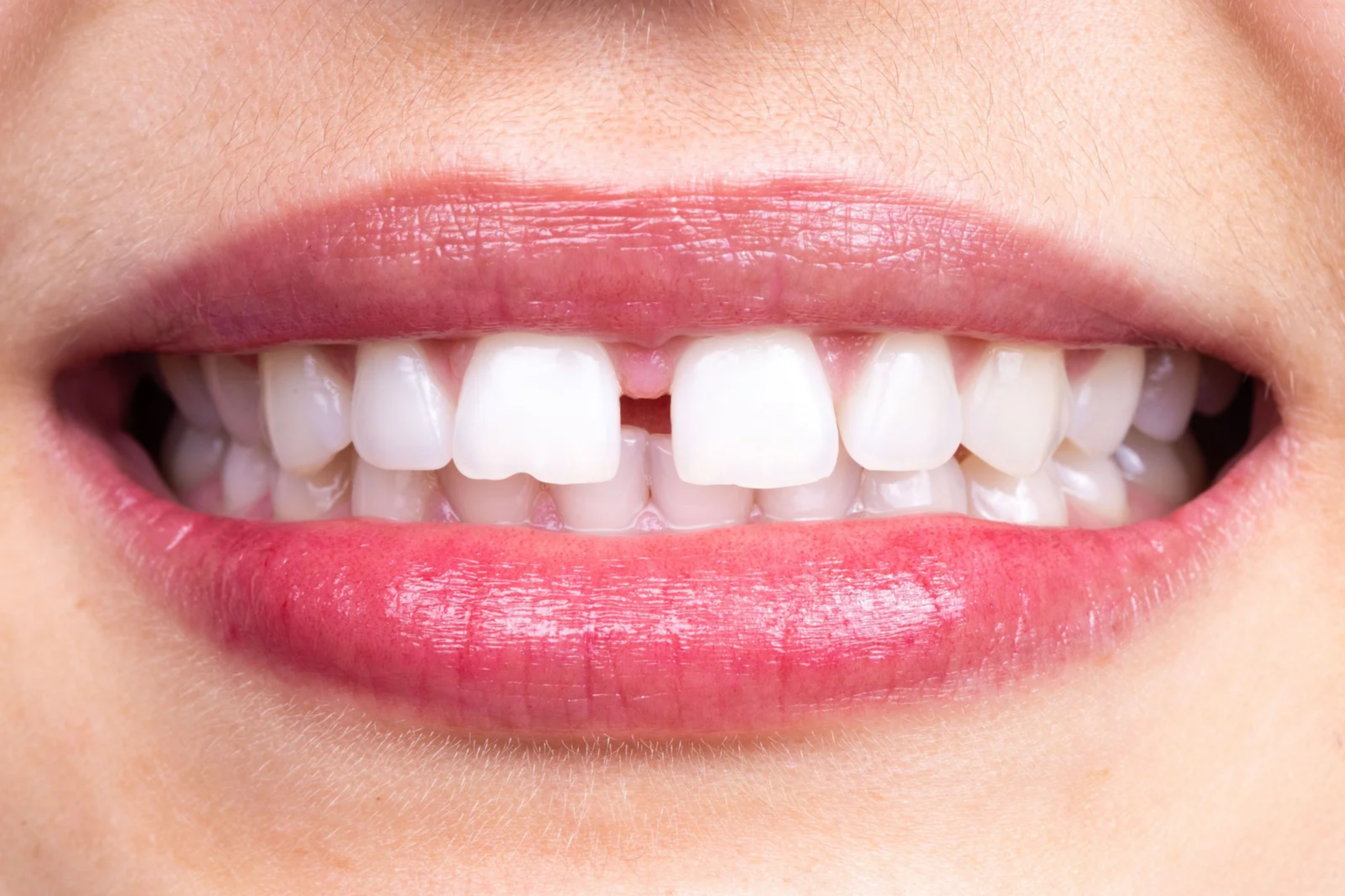 diastema: come correggere e prevenire lo spazio tra i denti