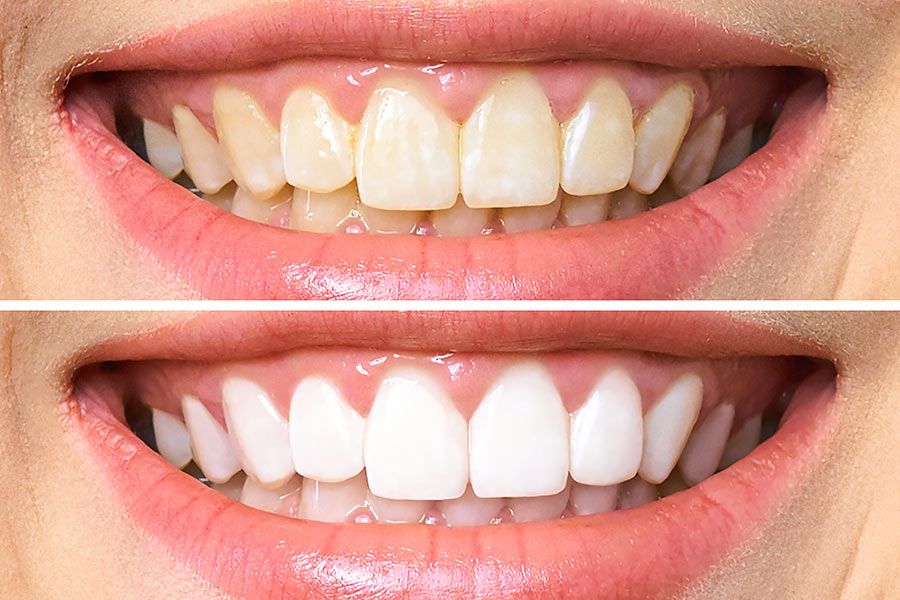 Qual è la causa dei denti neri?