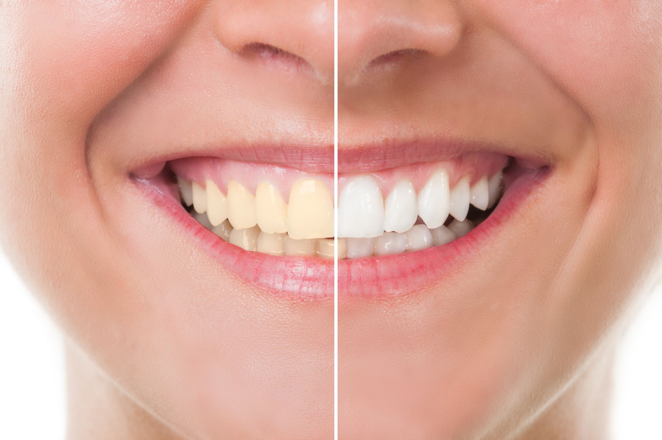 Denti ingialliti improvvisamente: cause e soluzioni