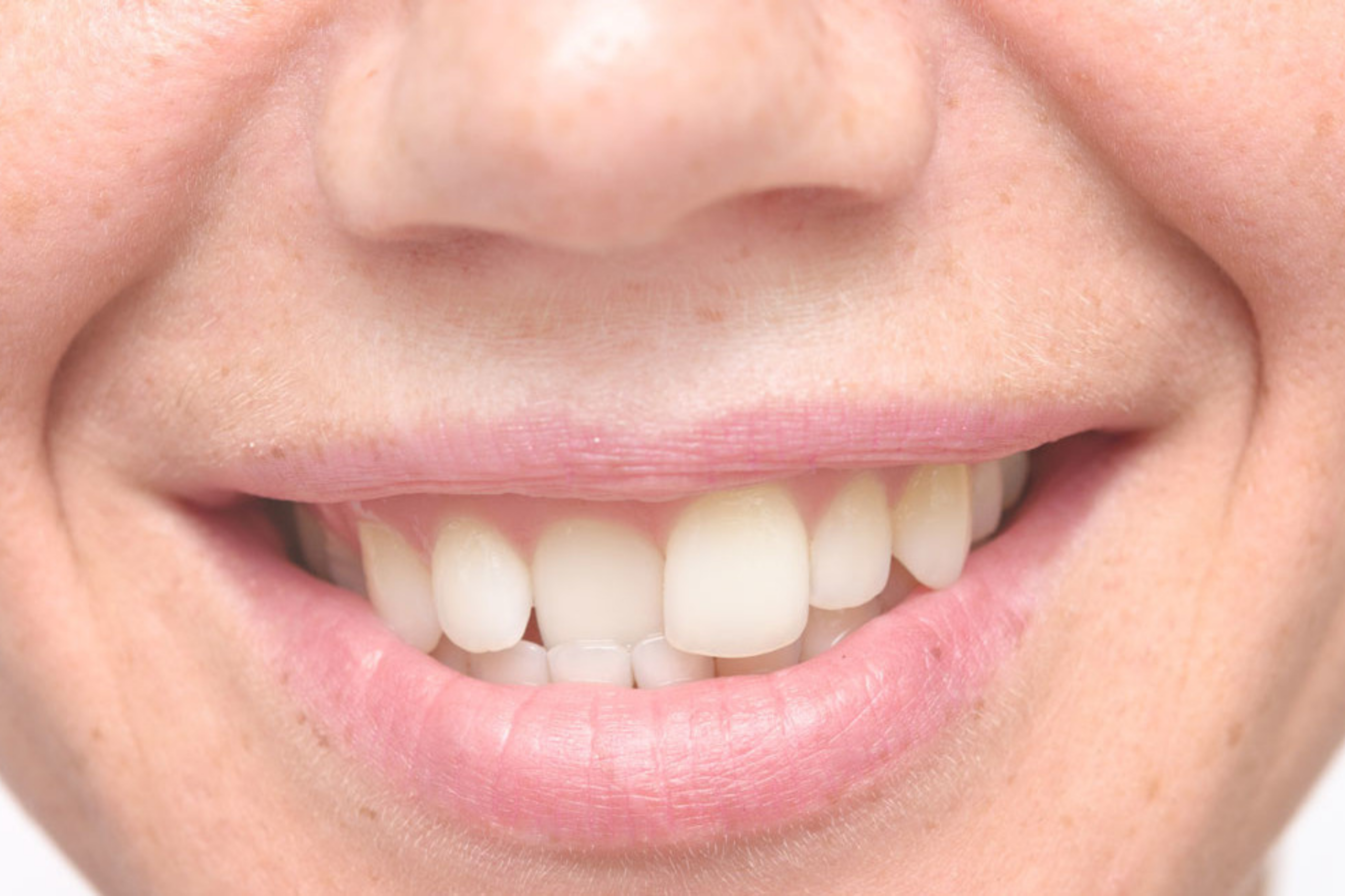 correggere i denti storti