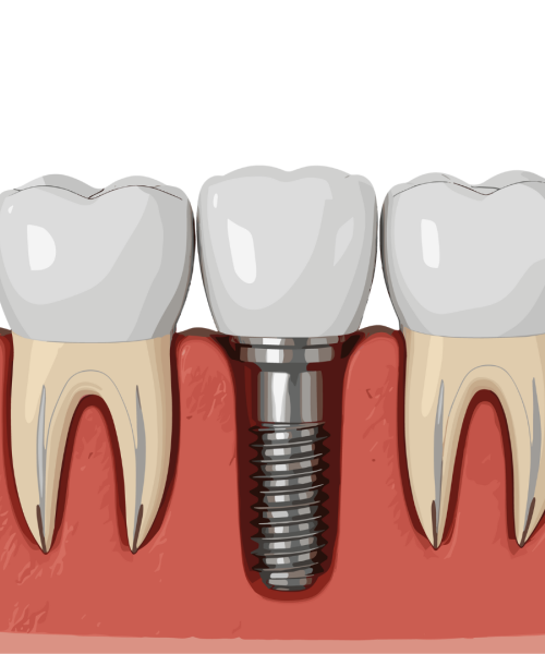 impianti dentali milano