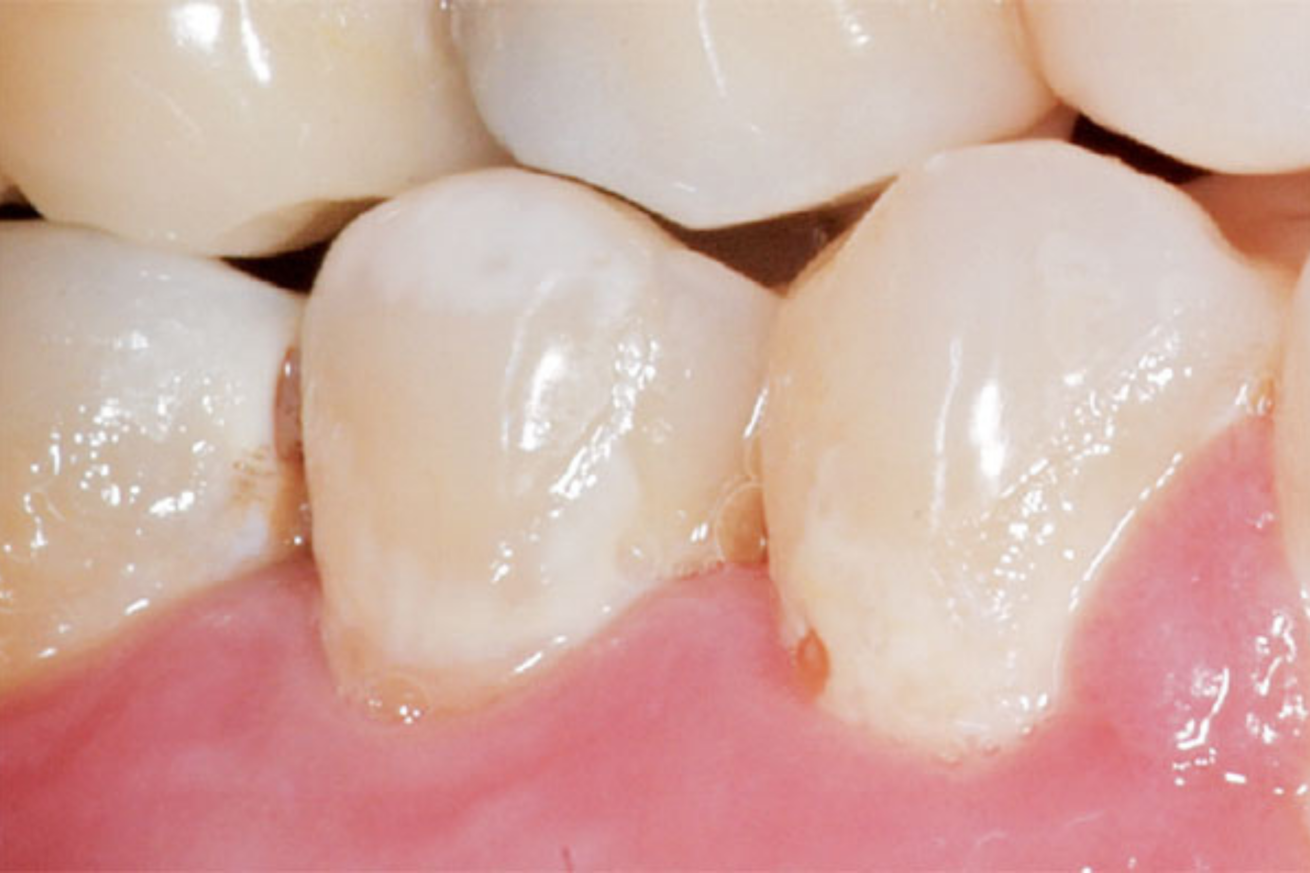 erosione dello smalto dei denti